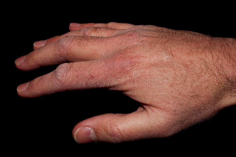 Close-up of a man's right hand with dry skin. Close-up of a man's right hand with dry skin
