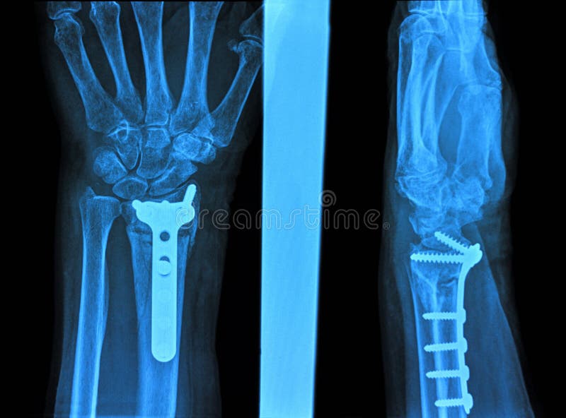 Xray ręka obraz royalty free