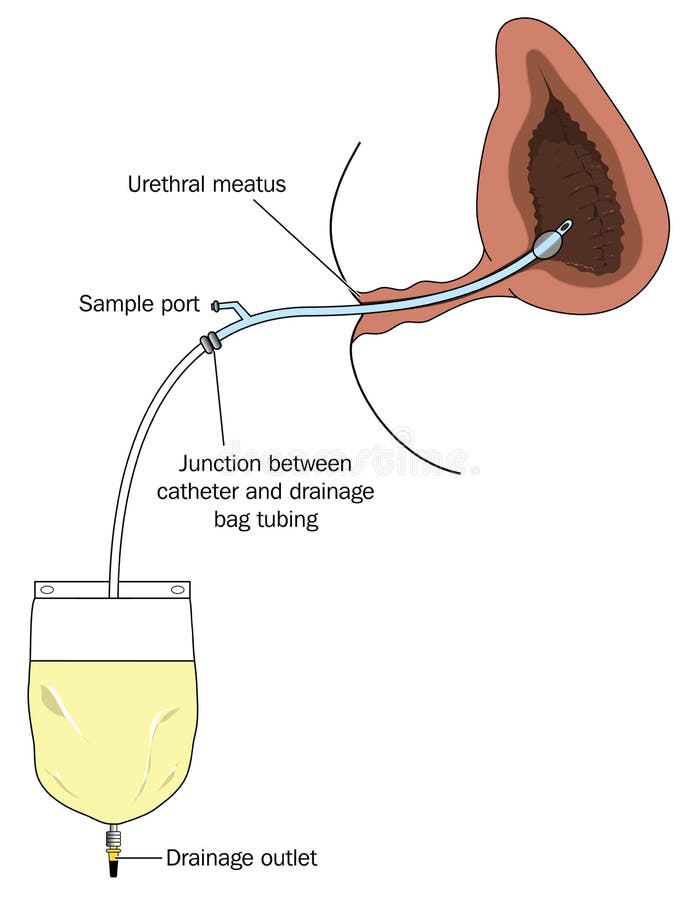 Sacchetto di raccolta della vescica urinaria