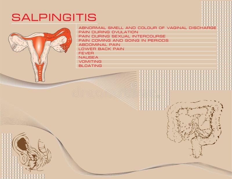 Salpingitis. Inflammation Of The Fallopian Tube. Oophoritis. Inflammation  Of The Ovary. Pelvic Organs. Infographics. Vector Illustration On Isolated  Background. Royalty Free SVG, Cliparts, Vectors, and Stock Illustration.  Image 68281130.