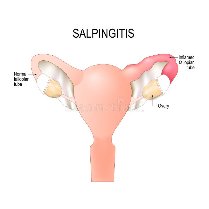 Salpingitis inflamación en los tubos de falopio libre illustration Salpingitis inflamación en los tubos de falopio libre illustration