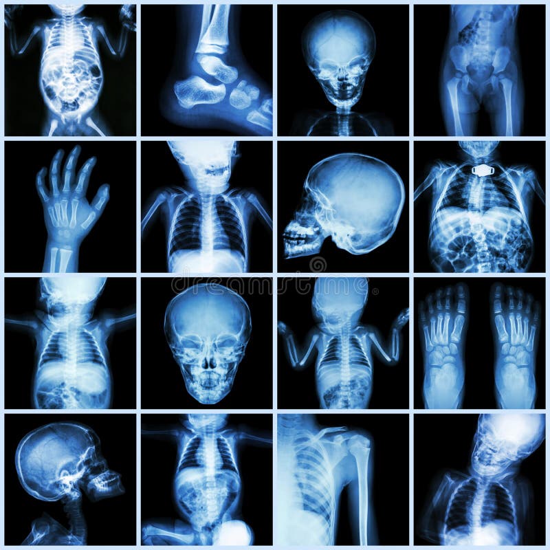 Samlingsröntgenstråledel av barnkroppen