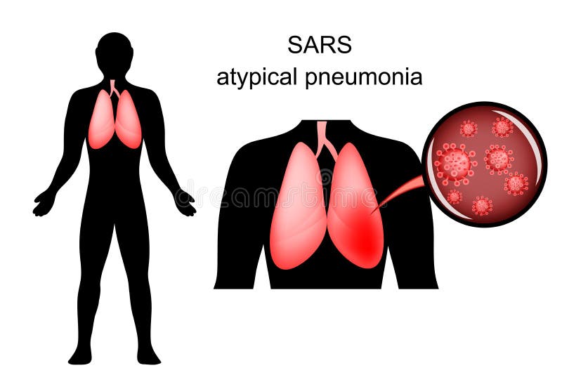 SARS zaogneni płuca i kauzatywny agent ilustracja wektor