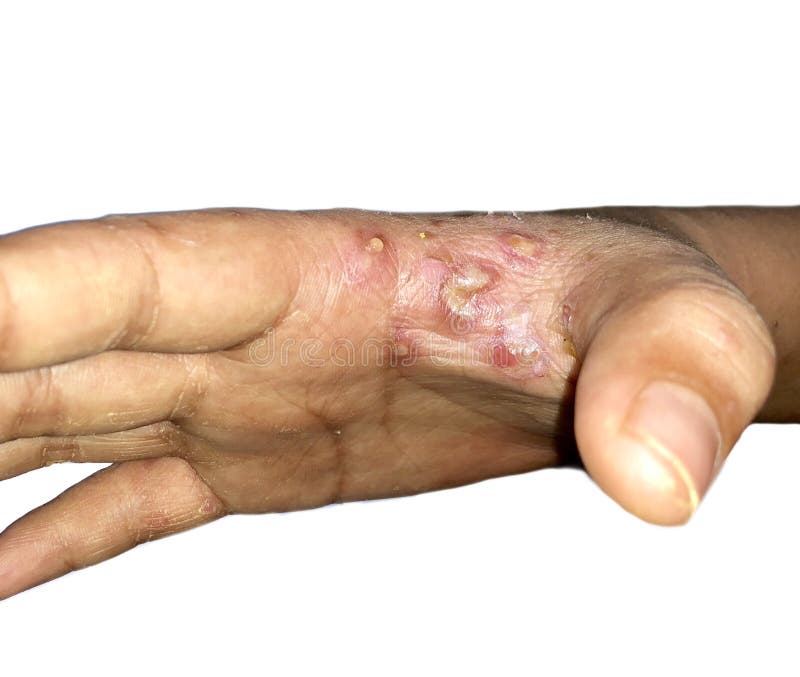 711 Scabies Photos Free Royalty Free Stock Photos From Dreamstime