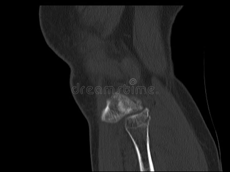 Scan knee Fracture of intercondylar eminence of tibia. Compression fracture of posterior of lateral tibial plateau which involv