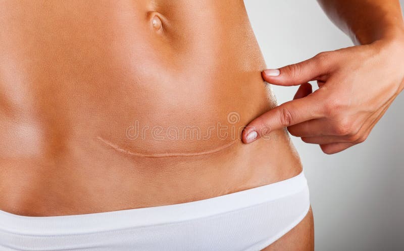 Scar of caesarean section royalty free stock photos