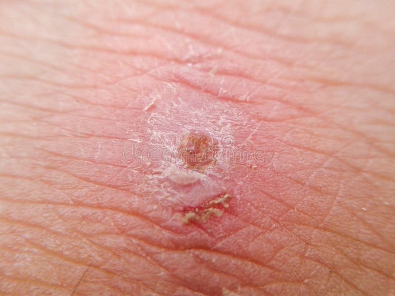 Scar on Skin. the Wound Form Scabs on Leg. Man with Long Scab Wound on