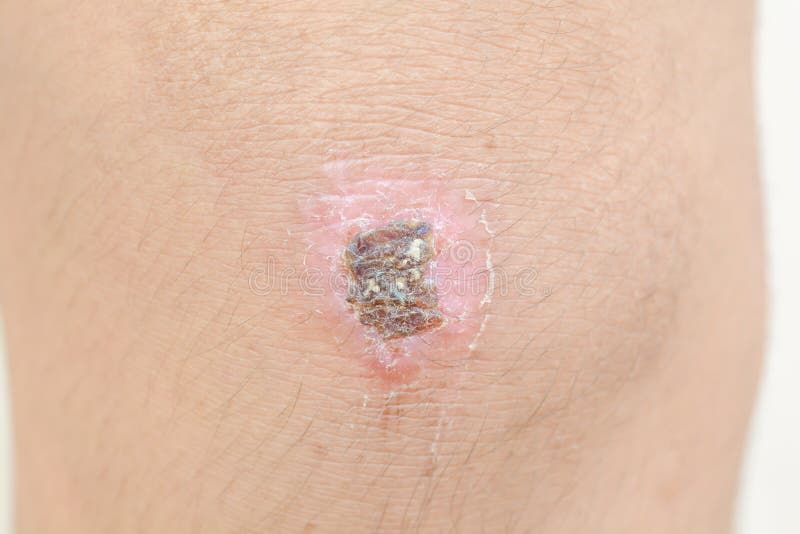 Scar on the knee stock photo. Image of medicine, injury 120001008