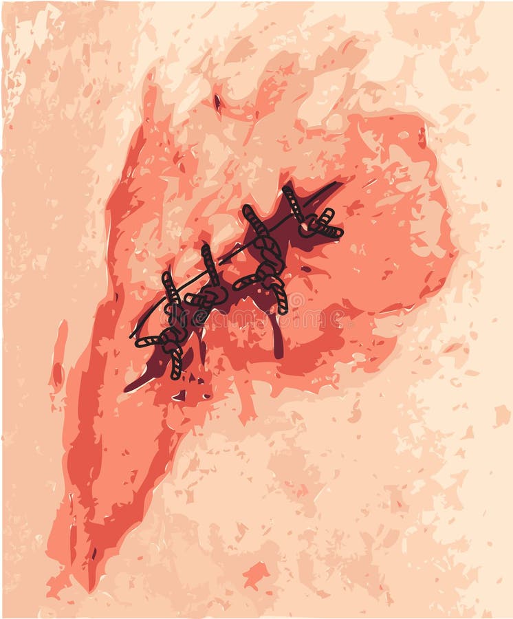 Wound and scar. stock vector. Illustration of injury 29825829