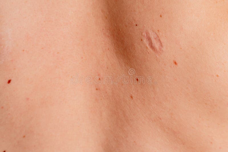 Scar on a Man`s Back after Removal of an Inflamed Boil, Scar, Closeup