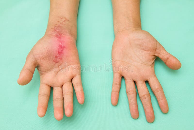 Scar wound on swollen and inflamed hand stock image Scar wound on swollen and inflamed hand stock image