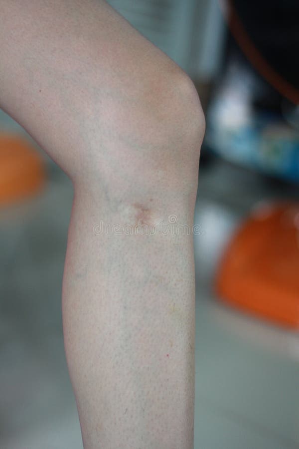 Closeup Of Young Woman Legs With Surgery Scar On Her Leg by