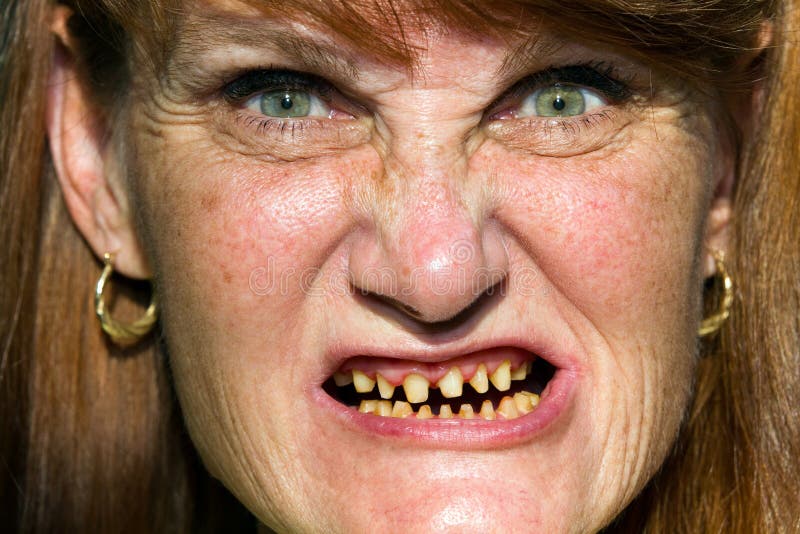 Mature woman whose teeth have be ground down in preparation for dental crow...