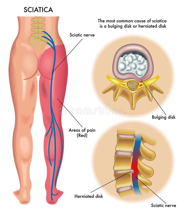 Sciatica vector illustration
