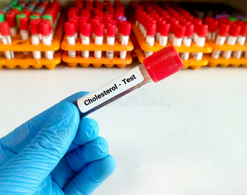 Blood Sample for Cholesterol Test Stock Photo Image of cardiac