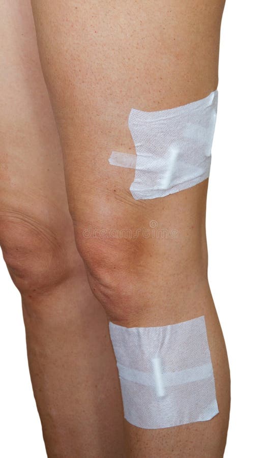 Sclerotherapy