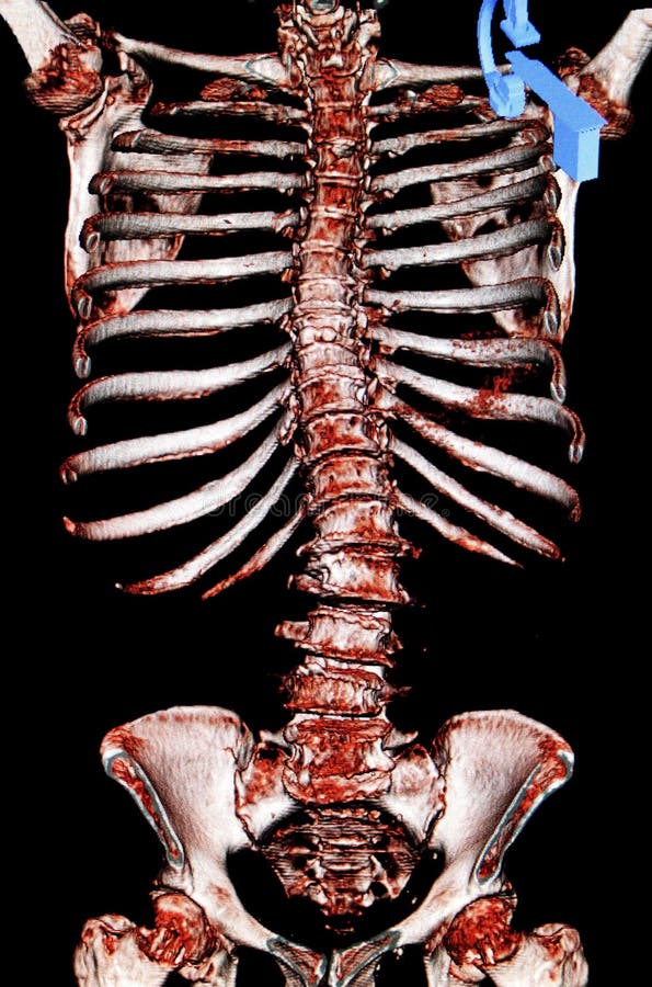 Scoliosi. Ricostruzione di CT-ricerca di Sceleton