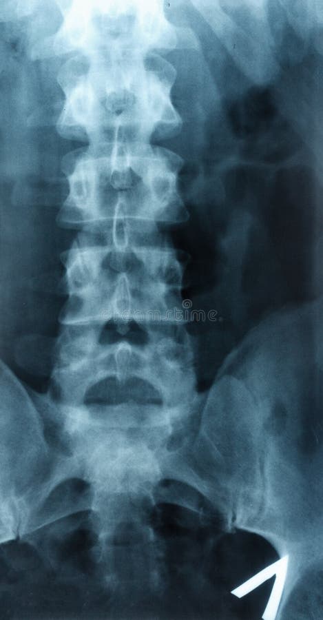 X-ray Scoliosis film x-ray lumbar spine AP stock photos X-ray Scoliosis film x-ray lumbar spine AP stock photos