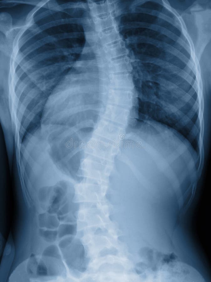 Scoliosi film di x-ray mostra la curvatura spinale nel paziente adolescente.