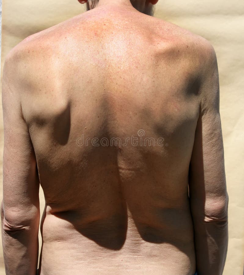 Scoliosis. Rachiocampsis. Kyphosis. Curvature of the spine royalty free stock image Scoliosis. Rachiocampsis. Kyphosis. Curvature of the spine royalty free stock image