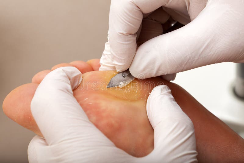Scrape off dry Skin royalty free stock image Scrape off dry Skin royalty free stock image