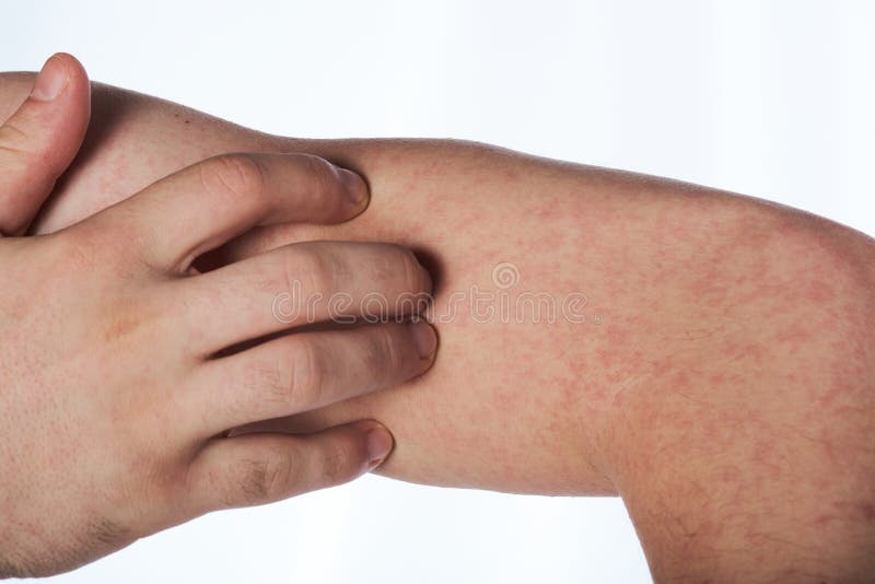 Scratching Hand with Allergy Rash Stock Photo Image of woman, eczema 75776844