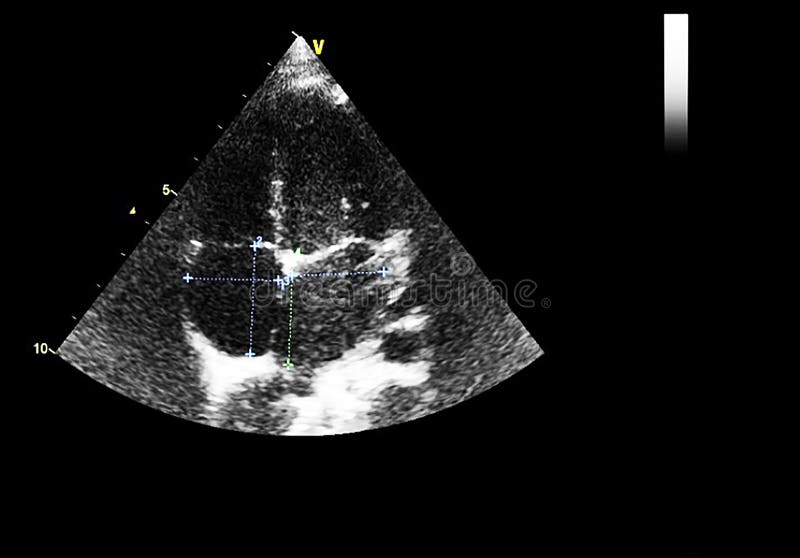 Screen of Echocardiography Ultrasound Machine Stock Image - Image of
