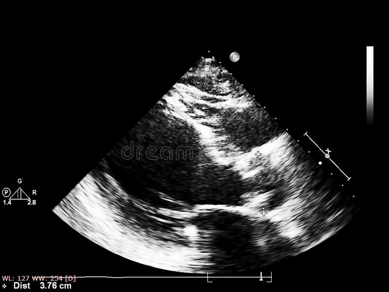 Screen of Echocardiography Ultrasound Machine Stock Image Image of