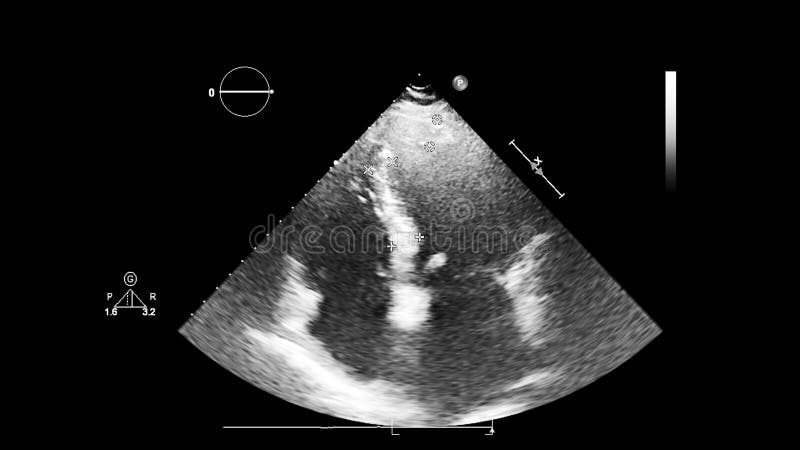 Screen of Echocardiography Ultrasound Machine Stock Photo - Image of