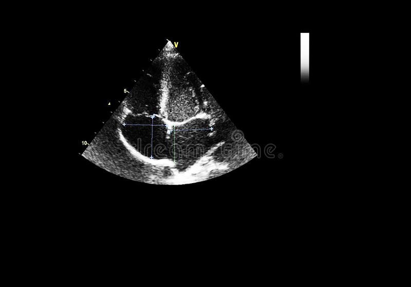 Screen of Echocardiography Ultrasound Machine Stock Image Image of