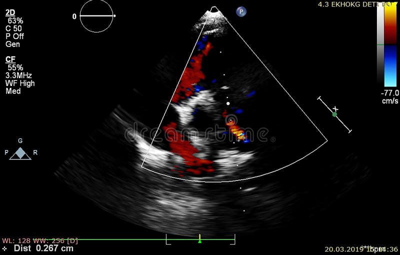 Screen of Echocardiography Ultrasound Machine Stock Image - Image of