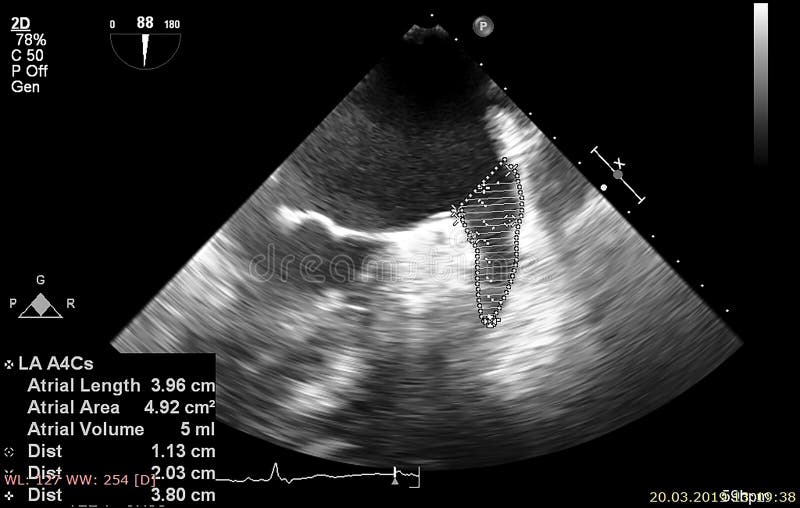 Screen of Echocardiography Ultrasound Machine Stock Image - Image of