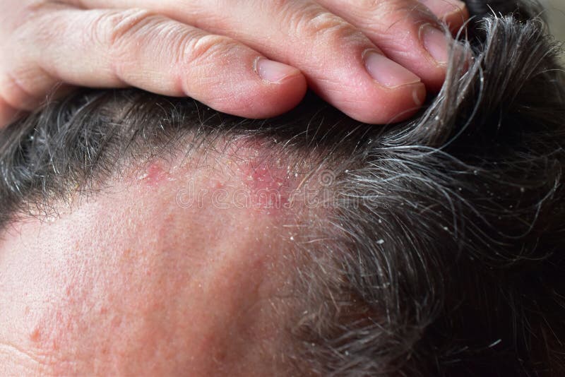 Seborrhea dermatitis hair dandruff