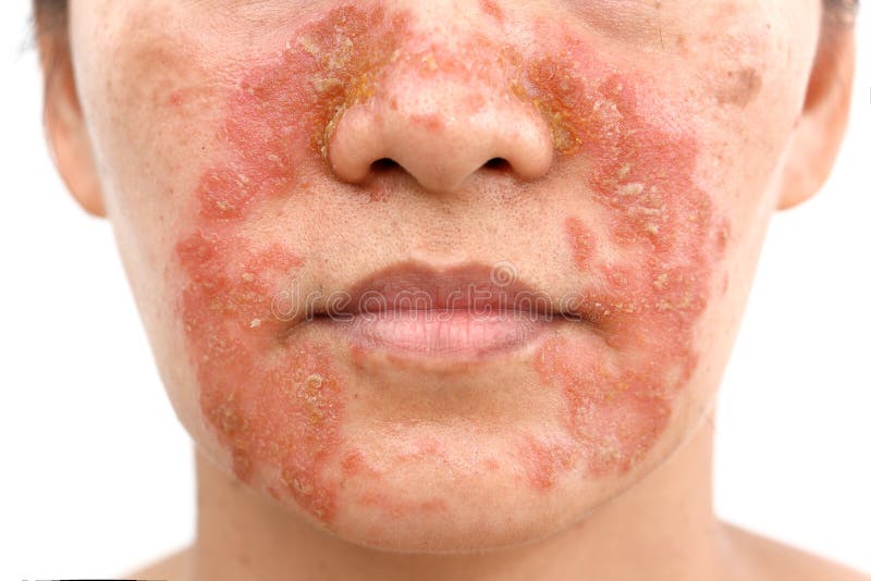 Seborrheic Dermatitis on face