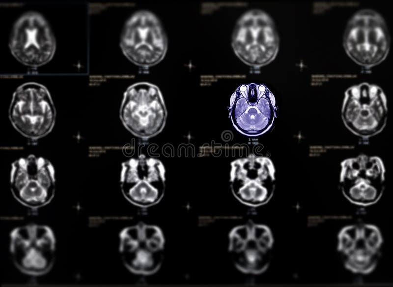 Selective focus of MRI brain axial view .