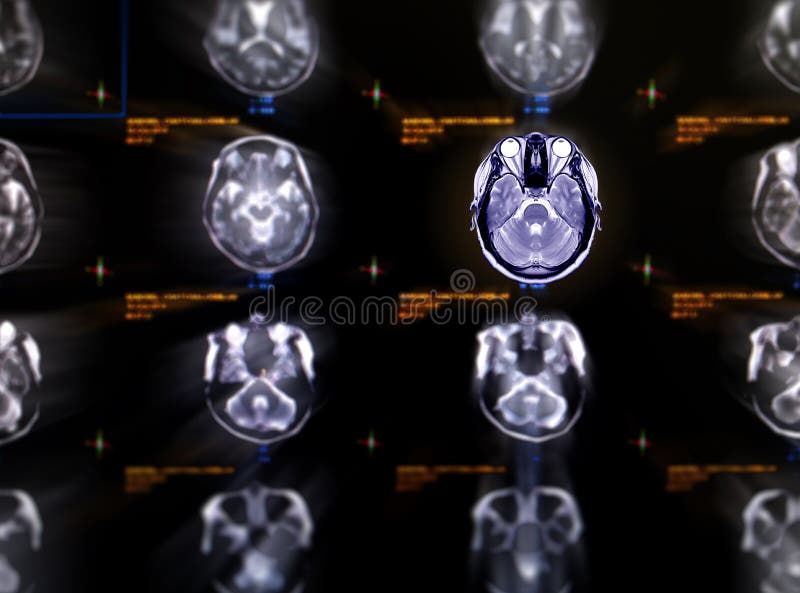 Selective focus of MRI brain axial view.