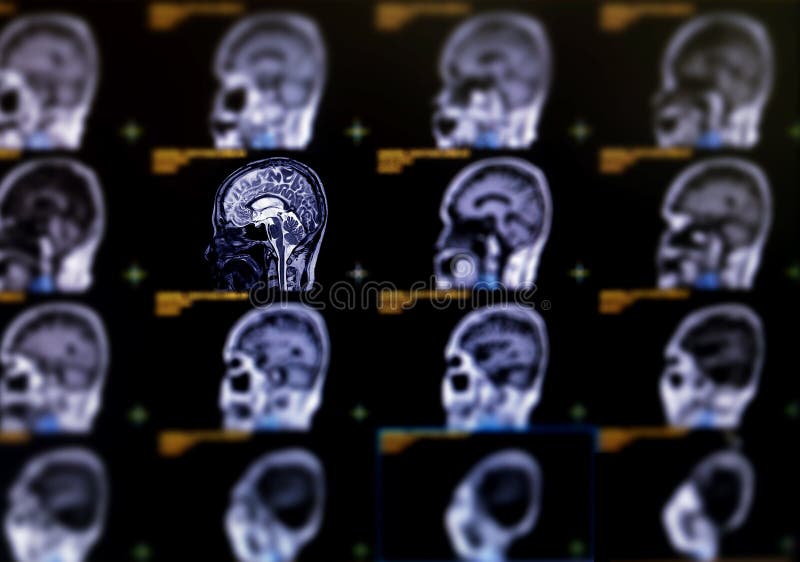 Selective focus of MRI brain sagittal plane