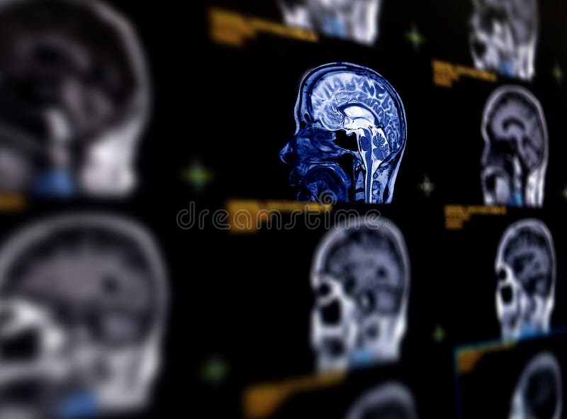 Selective focus of MRI brain sagittal plane.