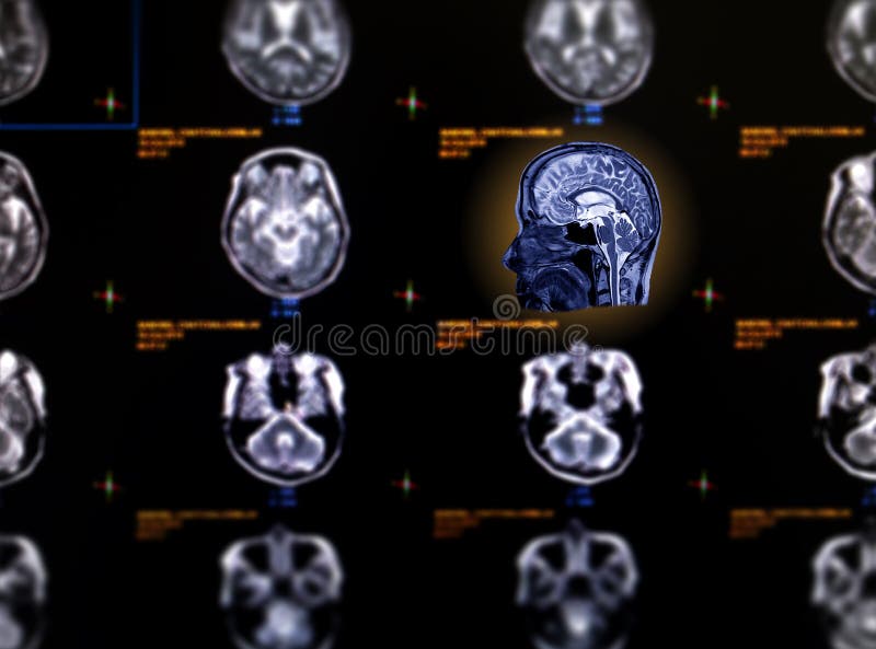 Selective focus of MRI brain sagittal view