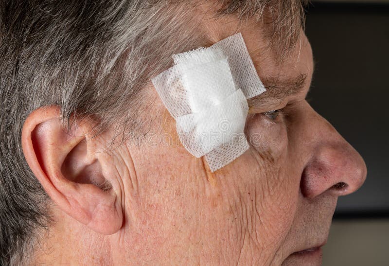 Side view of senior man after MOHS surgery to remove skin cancer with dressings