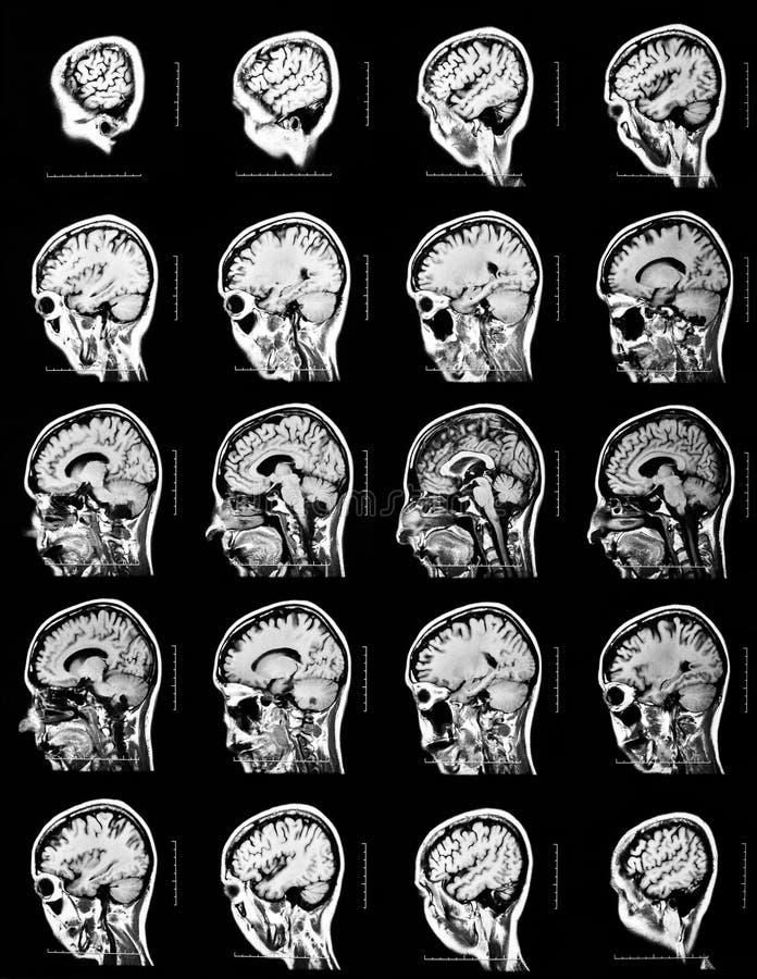 Sequence of vertical sections of a human brain - MRI scan