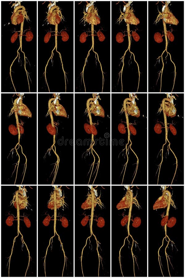 Serce, aorta i cynaderki na obliczającej tomografii, fotografia stock Serce, aorta i cynaderki na obliczającej tomografii, fotografia stock