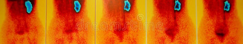 Serie renale di flusso, medicina nucleare immagini stock Serie renale di flusso, medicina nucleare immagini stock