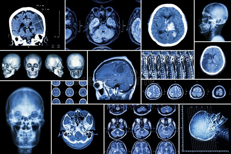 Set , Collection of brain disease ( Cerebral infarction , Hemorrhagic stroke , Brain tumor , Disc herniation with spinal cord compression ,etc)( CT scan , MRI , MRT )( Neurology and Nervous system )