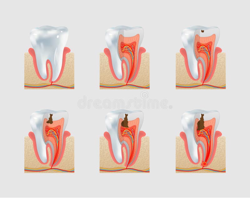 Set de pictograme pentru dinți și cariere dentare vector illustration