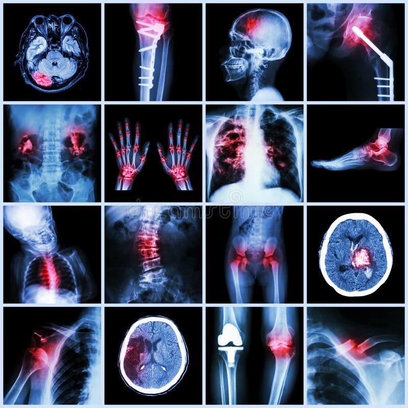 Set of X-ray multiple part of human, Multiple disease, orthopedic, surgery (Stroke, Bone fracture, Orthopedic operationKidney.
