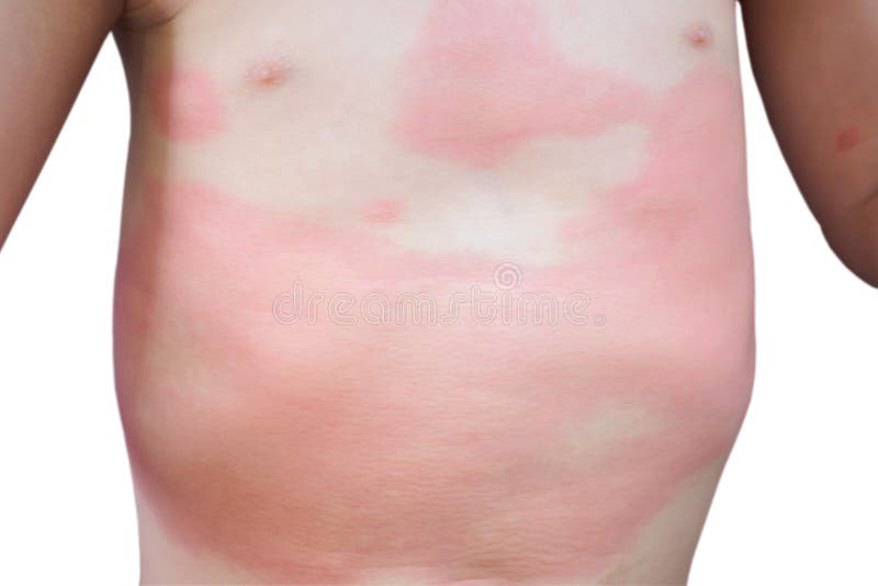 Severe eczema skin rash and allergic reaction symtom at little asian child body cause by hypersensitivity isolated on white. Background royalty free stock images Severe eczema skin rash and allergic reaction symtom at little asian child body cause by hypersensitivity isolated on white. Background royalty free stock images