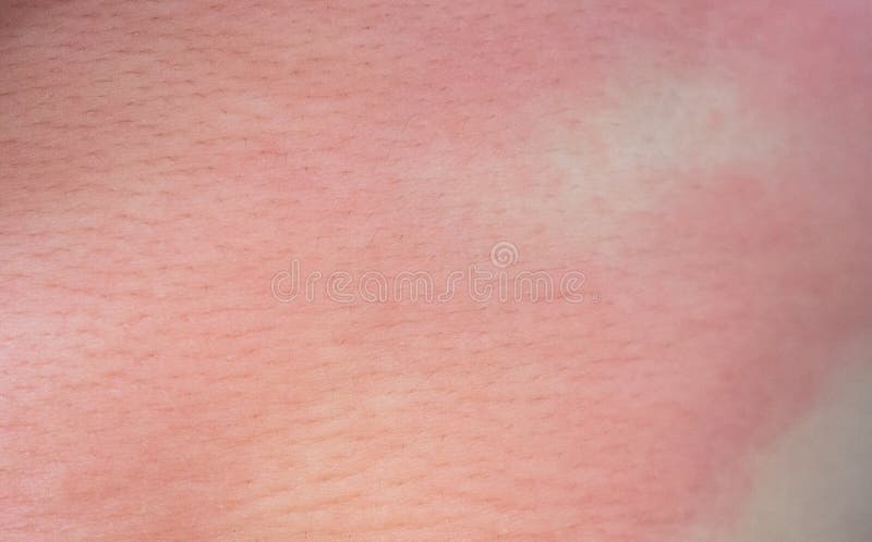 Eczema On Child Skin Stock Image Image Of Healthcare 15447053
