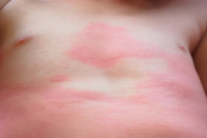 Severe eczema skin rash and allergic reaction symtom at little asian child body cause by hypersensitivity. Close up royalty free stock photography Severe eczema skin rash and allergic reaction symtom at little asian child body cause by hypersensitivity. Close up royalty free stock photography