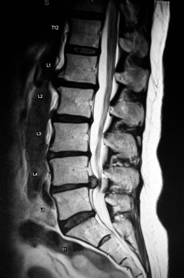 There is pathology of lumbar spine on the level of L4- L5 discs where herniation severely compressed cauda equina revealed by MRI and due to this patient suffering with permanent pain in the back and pelvis . There is pathology of lumbar spine on the level of L4- L5 discs where herniation severely compressed cauda equina revealed by MRI and due to this patient suffering with permanent pain in the back and pelvis .